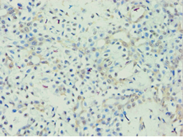 APOL1 / Apolipoprotein L Antibody - Immunohistochemistry of paraffin-embedded human breast cancer using antibody at 1:100 dilution.