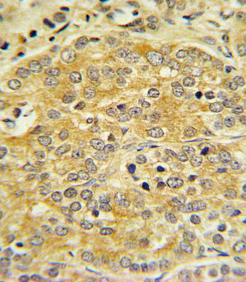 APOL1 / Apolipoprotein L Antibody - APOL1 Antibody IHC of formalin-fixed and paraffin-embedded human Prostate carcinoma followed by peroxidase-conjugated secondary antibody and DAB staining.
