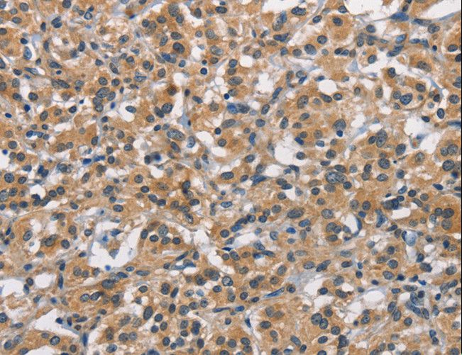 APOL1 / Apolipoprotein L Antibody - Immunohistochemistry of paraffin-embedded Human thyroid cancer using APOL1 Polyclonal Antibody at dilution of 1:40.