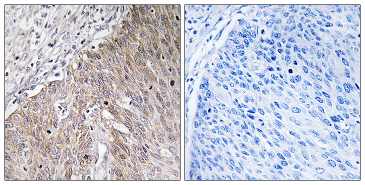 APOL2 / Apolipoprotein L 2 Antibody - Immunohistochemistry analysis of paraffin-embedded human cervix carcinoma tissue, using APOL2 Antibody. The picture on the right is blocked with the synthesized peptide.