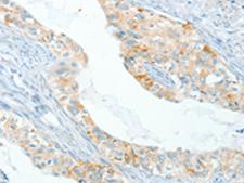 APOL2 / Apolipoprotein L 2 Antibody - Immunohistochemistry of paraffin-embedded Human cervical cancer tissue  using APOL2 Polyclonal Antibody at dilution of 1:80(×200)