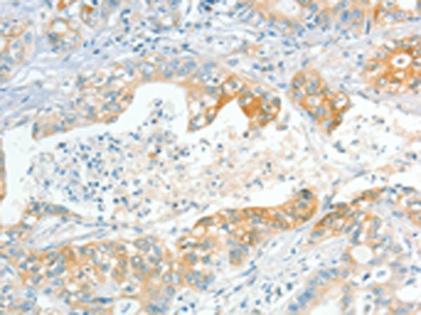 APOL2 / Apolipoprotein L 2 Antibody - Immunohistochemistry of paraffin-embedded Human gastric cancer tissue  using APOL2 Polyclonal Antibody at dilution of 1:80(×200)