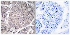 APOL4 / Apolipoprotein L 4 Antibody - Immunohistochemistry analysis of paraffin-embedded human liver carcinoma tissue, using APOL4 Antibody. The picture on the right is blocked with the synthesized peptide.