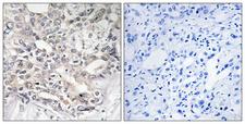 APOL5 / Apolipoprotein L 5 Antibody - Immunohistochemistry analysis of paraffin-embedded human liver carcinoma tissue, using APOL5 Antibody. The picture on the right is blocked with the synthesized peptide.