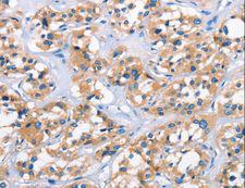 APOL6 / Apolipoprotein L 6 Antibody - Immunohistochemistry of paraffin-embedded Human thyroid cancer using APOL6 Polyclonal Antibody at dilution of 1:50.