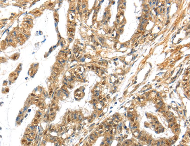 APOL6 / Apolipoprotein L 6 Antibody - Immunohistochemistry of paraffin-embedded Human thyroid cancer using APOL6 Polyclonal Antibody at dilution of 1:60.