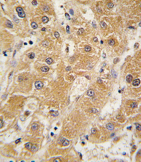 Apolipoprotein A-V Antibody - Formalin-fixed and paraffin-embedded human hepatocarcinoma tissue reacted with APOA5 antibody , which was peroxidase-conjugated to the secondary antibody, followed by DAB staining. This data demonstrates the use of this antibody for immunohistochemistry; clinical relevance has not been evaluated.