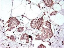 Apolipoprotein A-V Antibody - IHC of paraffin-embedded Adenocarcinoma of Human breast tissue using anti-APOA5 mouse monoclonal antibody. (Heat-induced epitope retrieval by 1 mM EDTA in 10mM Tris, pH8.5, 120°C for 3min).