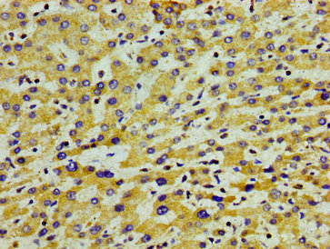 Apolipoprotein A-V Antibody - Immunohistochemistry image of paraffin-embedded human liver cancer at a dilution of 1:100