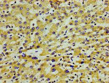 Apolipoprotein A-V Antibody - Immunohistochemistry image of paraffin-embedded human liver cancer at a dilution of 1:100