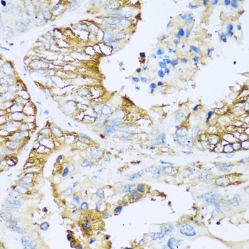 Apolipoprotein C-I Antibody - Immunohistochemistry of paraffin-embedded human colon carcinoma tissue.
