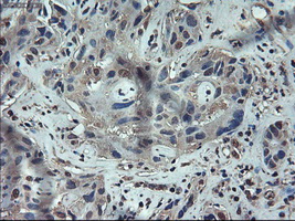 APOM / Apolipoprotein M Antibody - IHC of paraffin-embedded Carcinoma of liver using anti-APOM mouse monoclonal antibody.