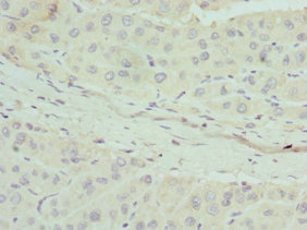 APOM / Apolipoprotein M Antibody - Immunohistochemistry of paraffin-embedded human liver cancer tissue at dilution 1:100