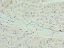 APOM / Apolipoprotein M Antibody - Immunohistochemistry of paraffin-embedded human liver cancer tissue at dilution 1:100