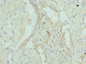 APOM / Apolipoprotein M Antibody - Immunohistochemistry of paraffin-embedded human lung cancer tissue at dilution 1:100