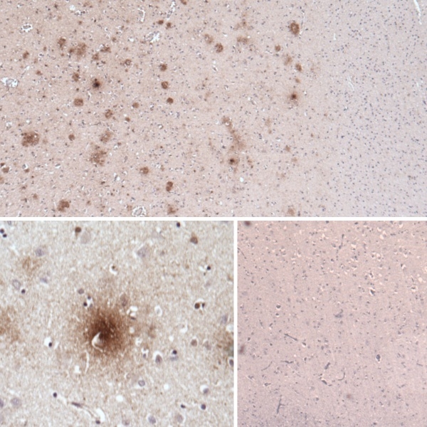 APP / Beta Amyloid Precursor Antibody - Immunohistochemistry of paraffin-embedded human Alzheimer's disease brain tissue with Mouse anti-Human beta amyloid (aa37-42) and detected using a Goat anti-Mouse IgG:HRP secondary antibody. Top image: 5x magnification showing diffuse plaques in Alzheimer's disease brain. Bottom left image: 20x magnification showing diffuse plaques in Alzheimer's disease brain. Bottom right image: Alzheimer's disease brain stained with an unrelated antibody as negative control