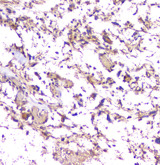 APP / Beta Amyloid Precursor Antibody - IHC analysis of APP using anti-APP antibody. APP was detected in paraffin-embedded section of human glioma tissue. Heat mediated antigen retrieval was performed in citrate buffer (pH6, epitope retrieval solution) for 20 mins. The tissue section was blocked with 10% goat serum. The tissue section was then incubated with 1µg/ml rabbit anti-APP Antibody overnight at 4°C. Biotinylated goat anti-rabbit IgG was used as secondary antibody and incubated for 30 minutes at 37°C. The tissue section was developed using Strepavidin-Biotin-Complex (SABC) with DAB as the chromogen.