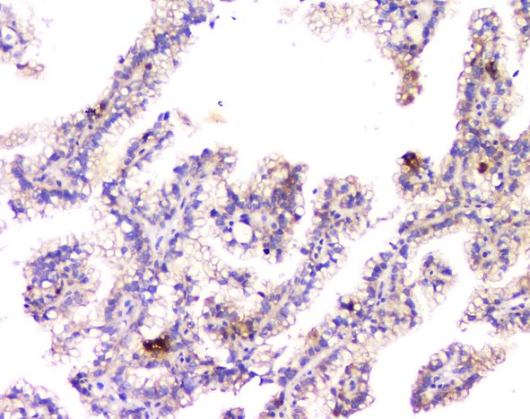 APP / Beta Amyloid Precursor Antibody - IHC analysis of APP using anti-APP antibody. APP was detected in paraffin-embedded section of human renal cancer tissue. Heat mediated antigen retrieval was performed in citrate buffer (pH6, epitope retrieval solution) for 20 mins. The tissue section was blocked with 10% goat serum. The tissue section was then incubated with 1µg/ml rabbit anti-APP Antibody overnight at 4°C. Biotinylated goat anti-rabbit IgG was used as secondary antibody and incubated for 30 minutes at 37°C. The tissue section was developed using Strepavidin-Biotin-Complex (SABC) with DAB as the chromogen.