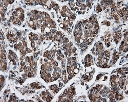 APP / Beta Amyloid Precursor Antibody - IHC of paraffin-embedded Carcinoma of Human liver tissue using anti-APP mouse monoclonal antibody.