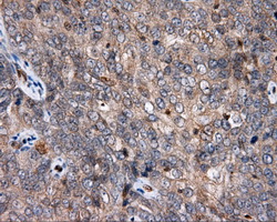 APP / Beta Amyloid Precursor Antibody - IHC of paraffin-embedded Adenocarcinoma of ovary tissue using anti-APP mouse monoclonal antibody. (Dilution 1:50).