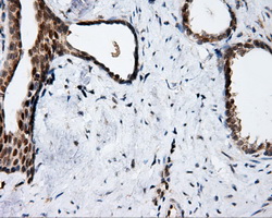 APP / Beta Amyloid Precursor Antibody - IHC of paraffin-embedded Carcinoma of prostate tissue using anti-APP mouse monoclonal antibody. (Dilution 1:50).