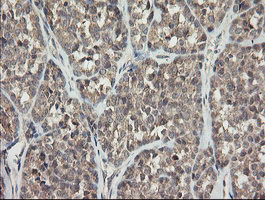 APP / Beta Amyloid Precursor Antibody - IHC of paraffin-embedded Carcinoma of Human thyroid tissue using anti-APP mouse monoclonal antibody.