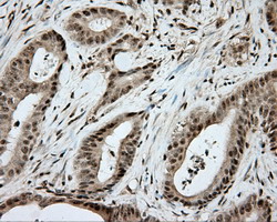 APP / Beta Amyloid Precursor Antibody - Immunohistochemical staining of paraffin-embedded Adenocarcinoma of Human colon tissue using anti-APP mouse monoclonal antibody.