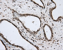 APP / Beta Amyloid Precursor Antibody - Immunohistochemical staining of paraffin-embedded Carcinoma of Human prostate tissue using anti-APP mouse monoclonal antibody.