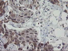 APP / Beta Amyloid Precursor Antibody - IHC of paraffin-embedded Adenocarcinoma of Human breast tissue using anti-APP mouse monoclonal antibody.