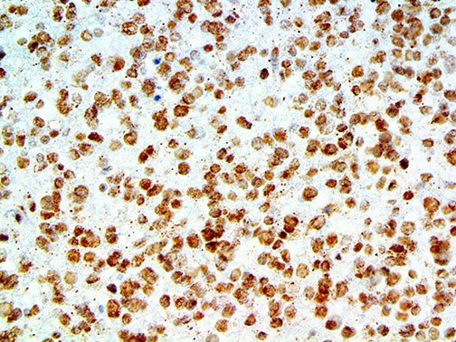 APP / Beta Amyloid Precursor Antibody - IHC of Amyloid Beta on an FFPE Astrocytoma Tissue