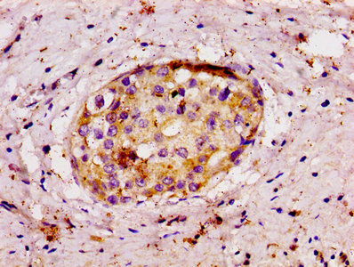 APP / Beta Amyloid Precursor Antibody - IHC image of Rabbit anti-human Amyloid beta A4 protein Apolyclonal Antibody diluted at 1:100 and staining in paraffin-embedded human breast cancer performed on a Leica BondTM system. After dewaxing and hydration, antigen retrieval was mediated by high pressure in a citrate buffer (pH 6.0). Section was blocked with 10% normal goat serum 30min at RT. Then primary antibody (1% BSA) was incubated at 4°C overnight. The primary is detected by a biotinylated secondary antibody and visualized using an HRP conjugated SP system.