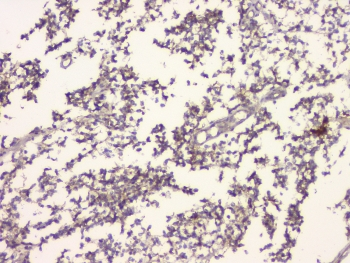 APP / Beta Amyloid Precursor Antibody - IHC staining of FFPE human glioma with APP antibody at 1ug/ml. HIER: boil tissue sections in pH6, 10mM citrate buffer, for 10-20 min and allow to cool before testing.