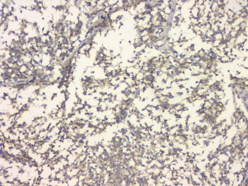 APP / Beta Amyloid Precursor Antibody - IHC staining of FFPE human glioma with APP antibody at 1ug/ml. HIER: boil tissue sections in pH6, 10mM citrate buffer, for 10-20 min and allow to cool before testing.