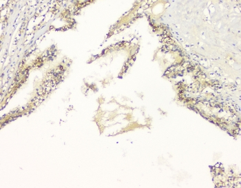 APP / Beta Amyloid Precursor Antibody - IHC staining of FFPE human renal cancer with APP antibody at 1ug/ml. HIER: boil tissue sections in pH6, 10mM citrate buffer, for 10-20 min and allow to cool before testing.