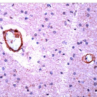 APP / Beta Amyloid Precursor Antibody - Alzheimer's brain stained with Anti-Amyloid beta.