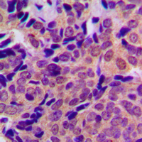 APP / Beta Amyloid Precursor Antibody - Immunohistochemical analysis of Beta Amyloid (pT743) staining in human breast cancer formalin fixed paraffin embedded tissue section. The section was pre-treated using heat mediated antigen retrieval with sodium citrate buffer (pH 6.0). The section was then incubated with the antibody at room temperature and detected using an HRP conjugated compact polymer system. DAB was used as the chromogen. The section was then counterstained with hematoxylin and mounted with DPX.