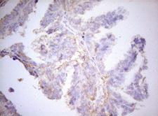 APPL1 / APPL Antibody - Immunohistochemical staining of paraffin-embedded Adenocarcinoma of Human ovary tissue using anti-APPL1 mouse monoclonal antibody. (Heat-induced epitope retrieval by 1mM EDTA in 10mM Tris buffer. (pH8.5) at 120°C for 3 min. (1:150)