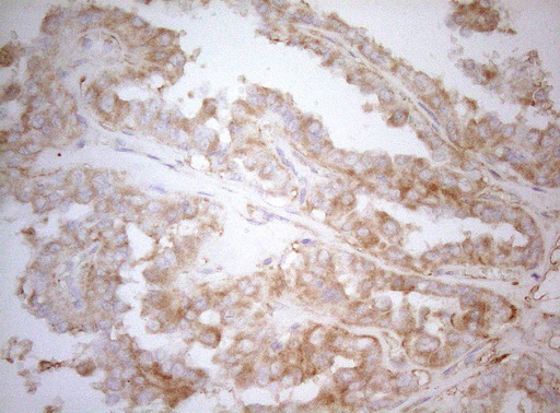 APPL1 / APPL Antibody - Immunohistochemical staining of paraffin-embedded Carcinoma of Human thyroid tissue using anti-APPL1 mouse monoclonal antibody. (Heat-induced epitope retrieval by 1mM EDTA in 10mM Tris buffer. (pH8.5) at 120°C for 3 min. (1:150)