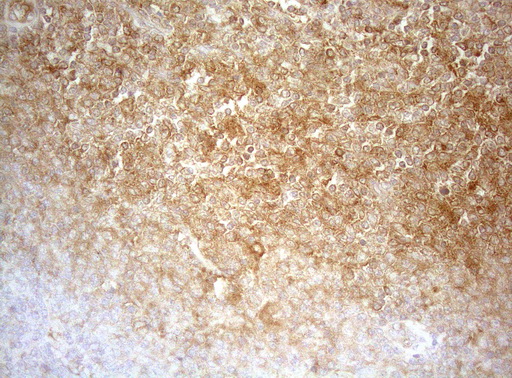 APPL1 / APPL Antibody - Immunohistochemical staining of paraffin-embedded Human lymphoma tissue using anti-APPL1 mouse monoclonal antibody. (Heat-induced epitope retrieval by 1mM EDTA in 10mM Tris buffer. (pH8.5) at 120°C for 3 min. (1:150)