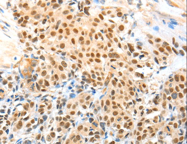 APPL1 / APPL Antibody - Immunohistochemistry of paraffin-embedded Human esophagus cancer using APPL1 Polyclonal Antibody at dilution of 1:70.