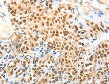 APPL1 / APPL Antibody - Immunohistochemistry of paraffin-embedded Human esophagus cancer using APPL1 Polyclonal Antibody at dilution of 1:70.