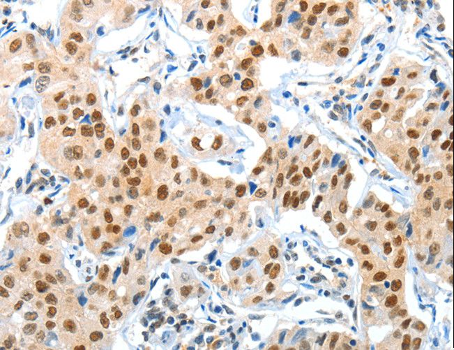 APPL1 / APPL Antibody - Immunohistochemistry of paraffin-embedded Human lung cancer using APPL1 Polyclonal Antibody at dilution of 1:70.