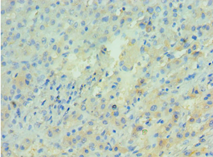APRT Antibody - Immunohistochemistry of paraffin-embedded human liver cancer using antibody at 1:100 dilution.