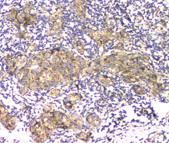 APRT Antibody - IHC staining of FFPE human breast cancer with APRT antibody at 1ug/ml. HIER: boil tissue sections in pH6, 10mM citrate buffer, for 10-20 min and allow to cool before testing.