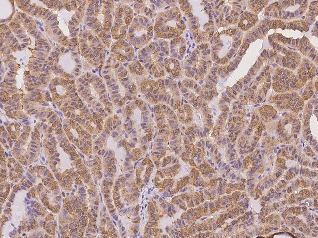 APRT Antibody - Immunochemical staining of human APRT in human thyroid carcinoma with rabbit polyclonal antibody at 1:100 dilution, formalin-fixed paraffin embedded sections.
