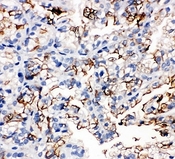 AQP1 / Aquaporin 1 Antibody - IHC-P: AQP1 antibody testing of human kidney cancer tissue