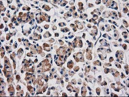 AQP1 / Aquaporin 1 Antibody - IHC of paraffin-embedded Adenocarcinoma of Human colon tissue using anti-AQP1 mouse monoclonal antibody. (Heat-induced epitope retrieval by 10mM citric buffer, pH6.0, 100C for 10min).