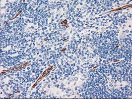 AQP1 / Aquaporin 1 Antibody - IHC of paraffin-embedded Human lymphoma tissue using anti-AQP1 mouse monoclonal antibody. (Heat-induced epitope retrieval by 10mM citric buffer, pH6.0, 100C for 10min).