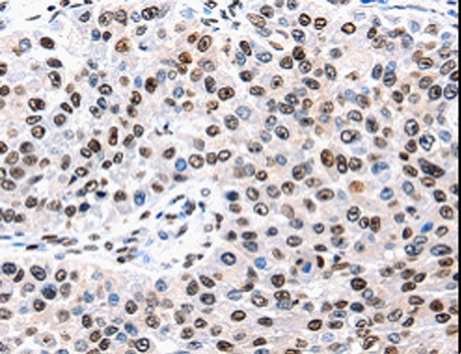 AQP2 / Aquaporin 2 Antibody - Immunohistochemistry of paraffin-embedded Human renal cancer using AQP2 Polyclonal Antibody at dilution of 1:50.