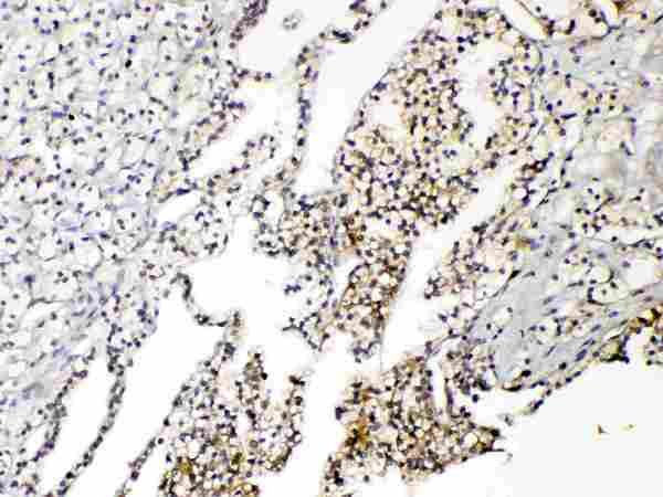 AQP3 / Aquaporin 3 Antibody - IHC analysis of Aquaporin 3 using anti-Aquaporin 3 antibody. Aquaporin 3 was detected in paraffin-embedded section of human renal cancer tissues. Heat mediated antigen retrieval was performed in citrate buffer (pH6, epitope retrieval solution) for 20 mins. The tissue section was blocked with 10% goat serum. The tissue section was then incubated with 1µg/ml rabbit anti-Aquaporin 3 Antibody overnight at 4°C. Biotinylated goat anti-rabbit IgG was used as secondary antibody and incubated for 30 minutes at 37°C. The tissue section was developed using Strepavidin-Biotin-Complex (SABC) with DAB as the chromogen.